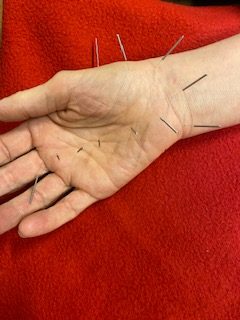 Koreańska akupunktura dłoni jest skuteczna nie tylko w przypadku problemów z dłonią a także przy dolegliwościach bólowych i związanych z nieprawidłowym funkcjonowaniem układów fizjologicznych w organizmie.