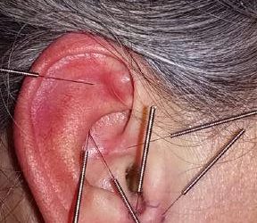 Aurikuloterapia – stymulacja punktów ucha